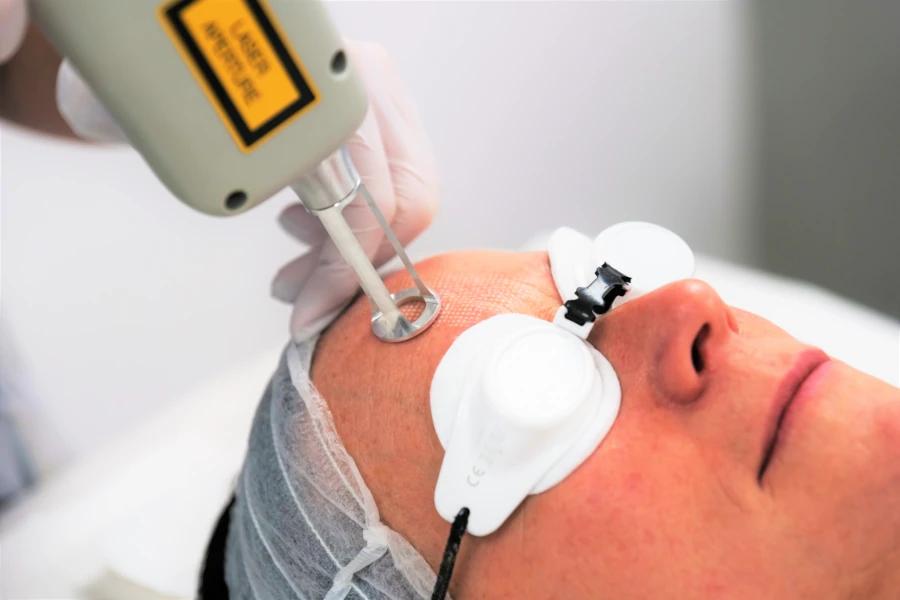 A client receiving a fractional laser treatment at Laser Care in Gravesend